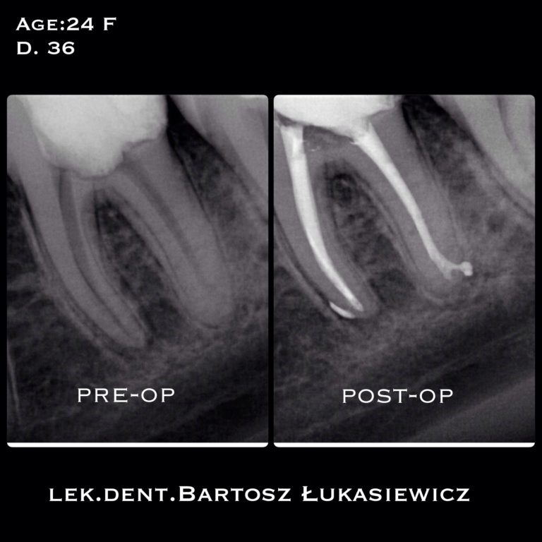 Endodoncja – Leczenie kanałowe
